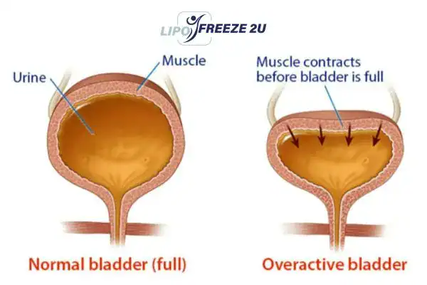 diagram of overactive bladder treatment Hitchin