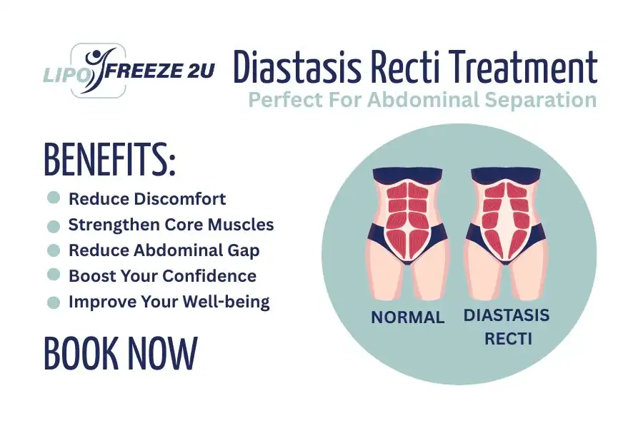 Benefits of body toning treatment Hitchin for Diastasis recti