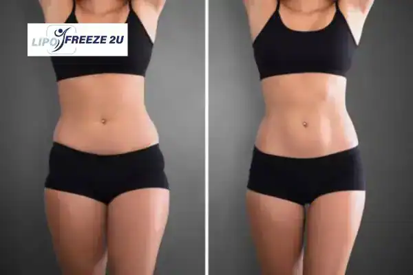 How Can LIPO FREEZE 2U Support Your Post-Pregnancy Body Recovery Hitchin?