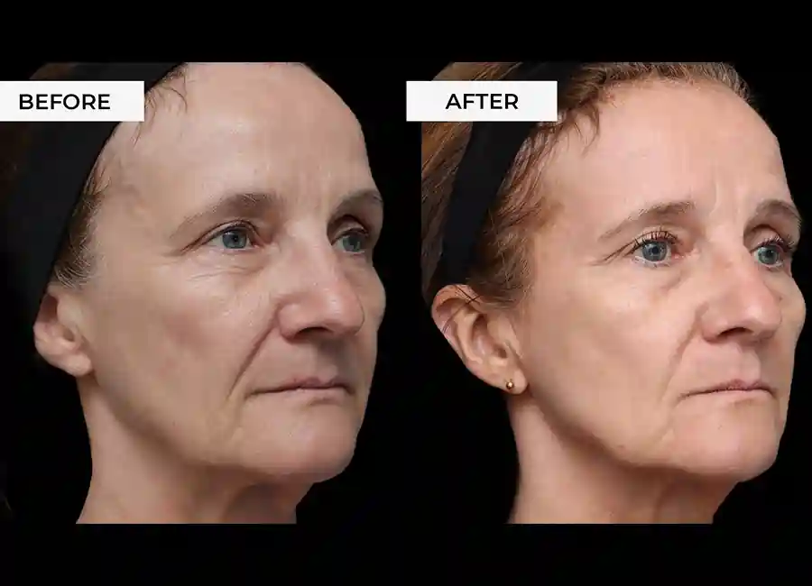 How Many RF Microneedling Sessions Will You Need to See a Difference Hitchin?