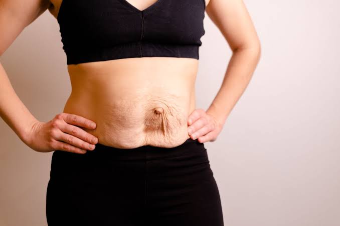 Is Surgery Really the Only Way to Repair Diastasis Recti Hitchin?